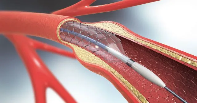 Peripheral Interventions